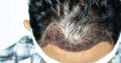 Hair transplants for men can result in scarring and are not always recommended