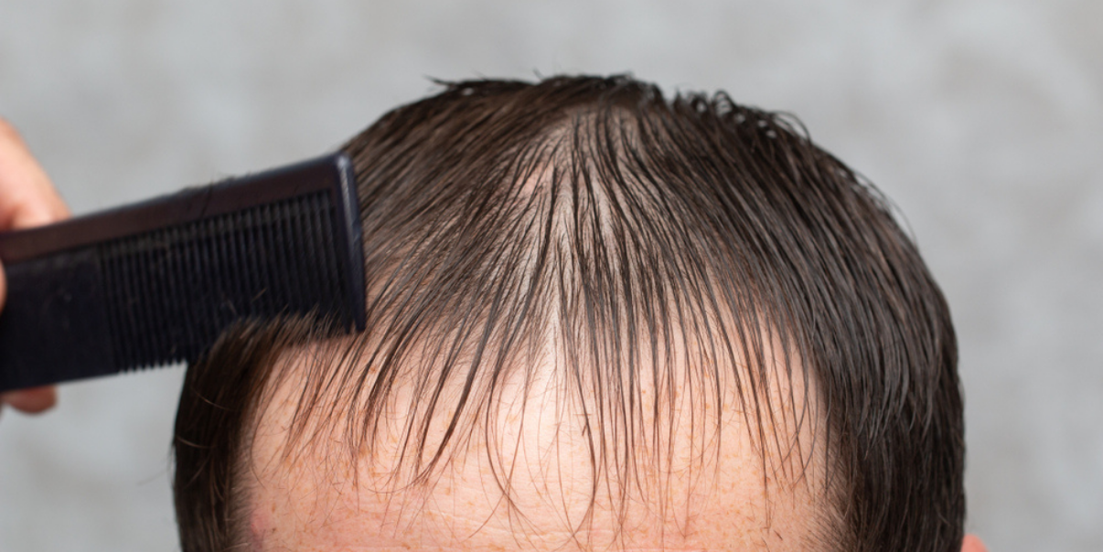 Man considering having a hair replacement