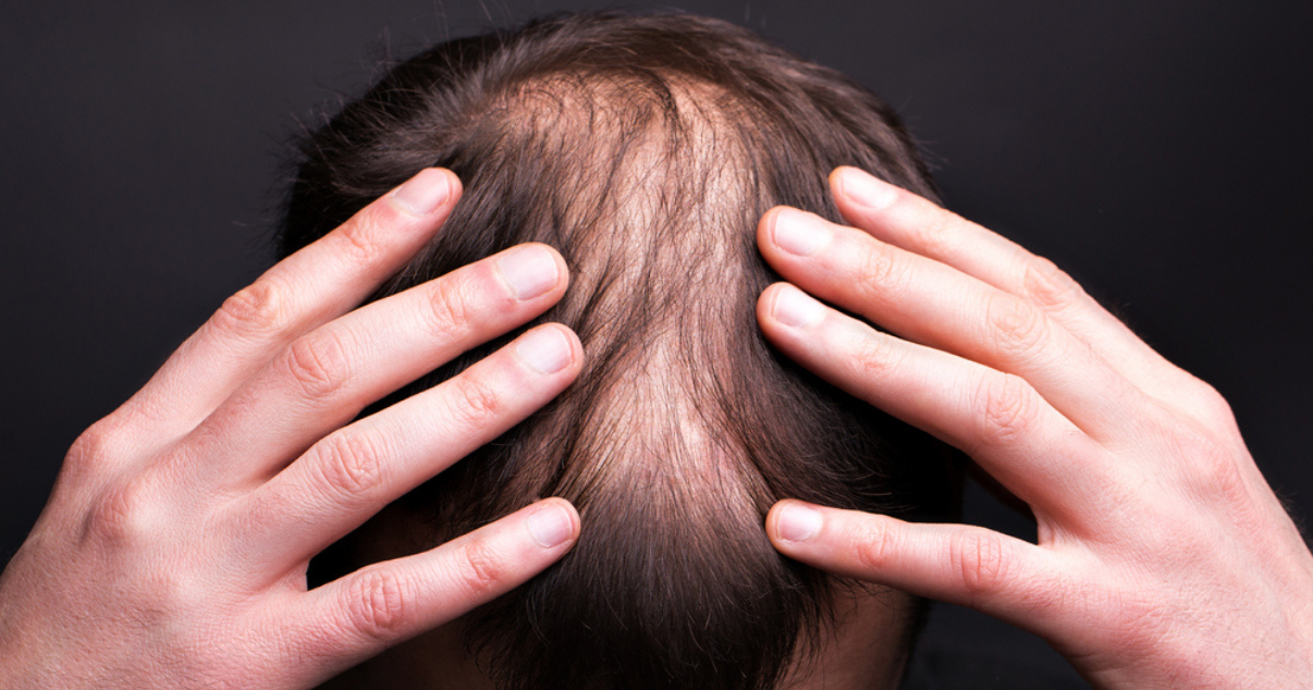 Man suffering of hairloss (1)