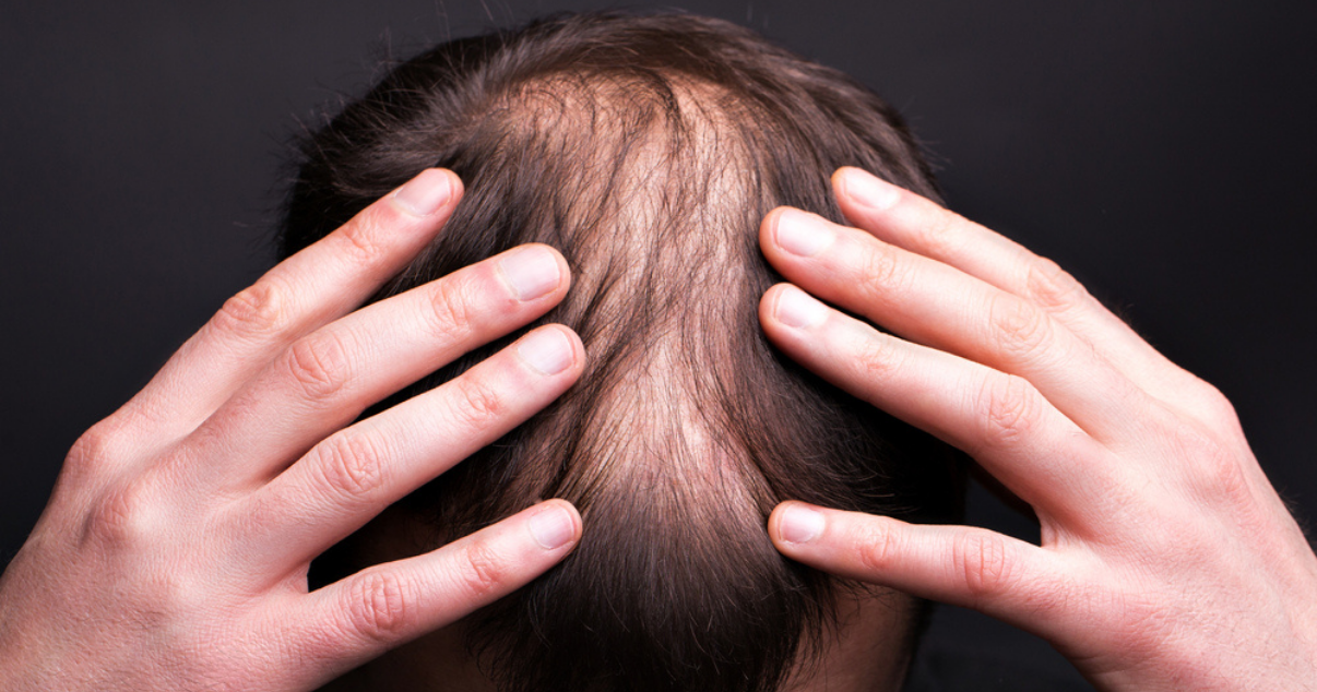 Man dealing with Hair loss 
